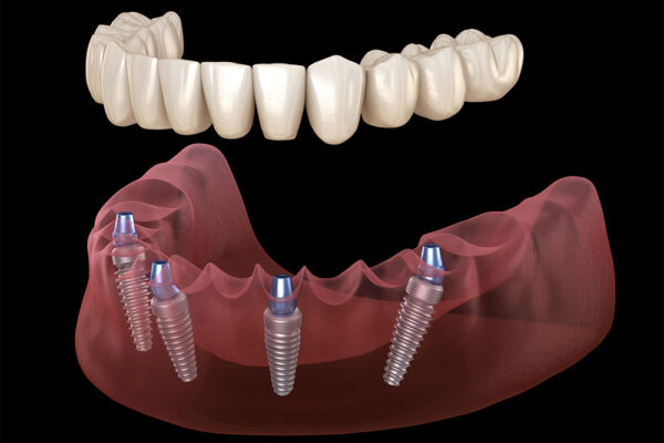 Are Dental Implants Safe for Seniors
